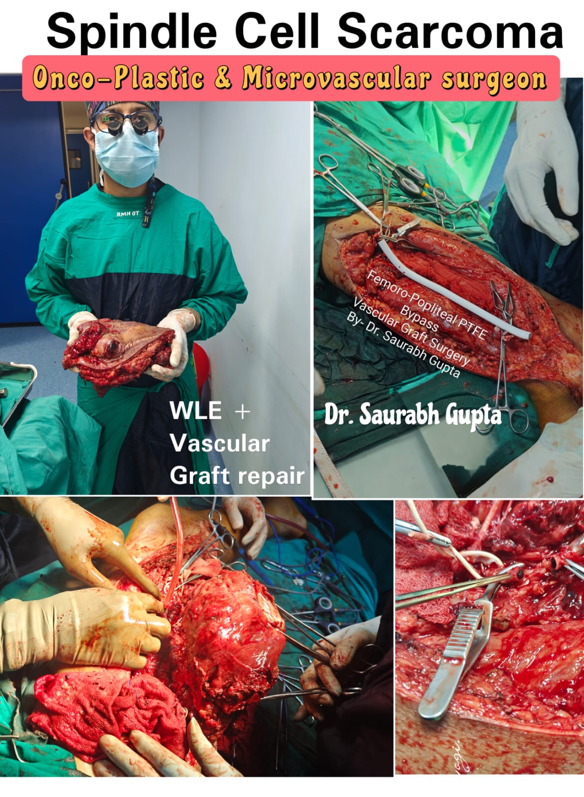 Bone Cancer Surgery with Limb Sparing Reconstruction in Jaipur