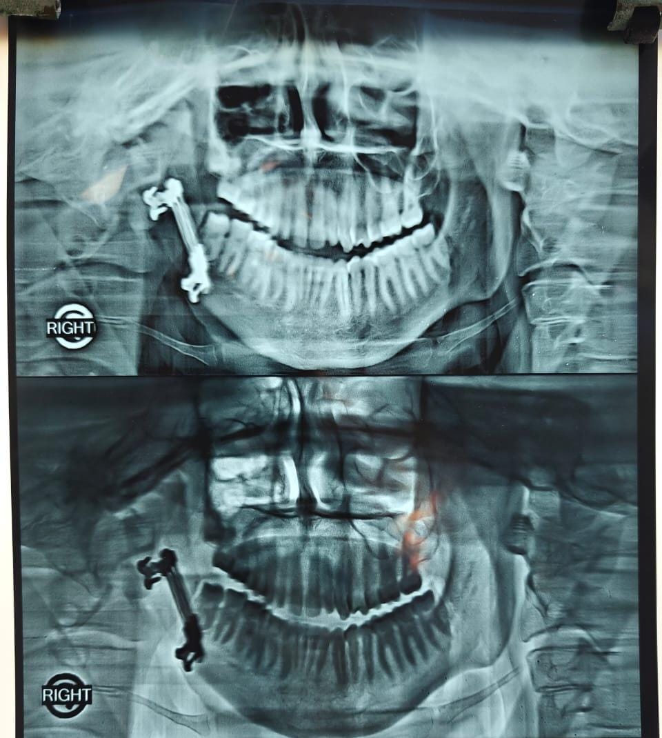 Jaw Lengthening Surgery