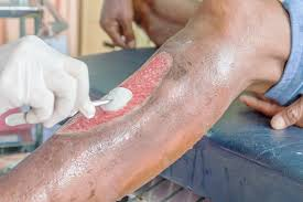 Complex Wound Management