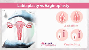 Gyne Vaginoplasty Surgery