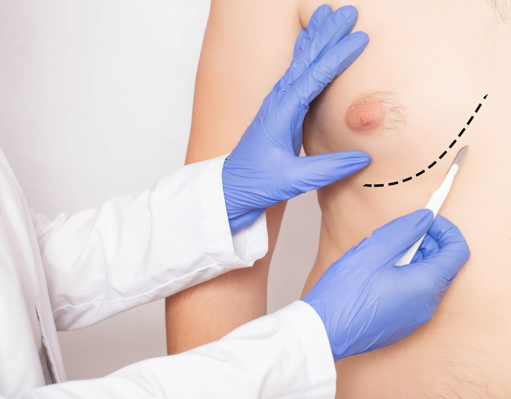 Gynecomastia Surgery
