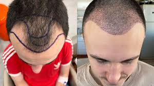 Hair Transplantation