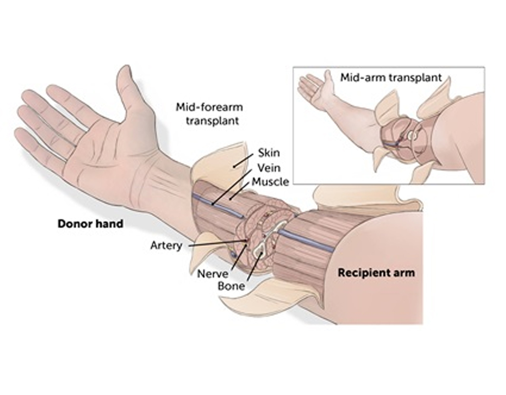Hand Transplant Surgery