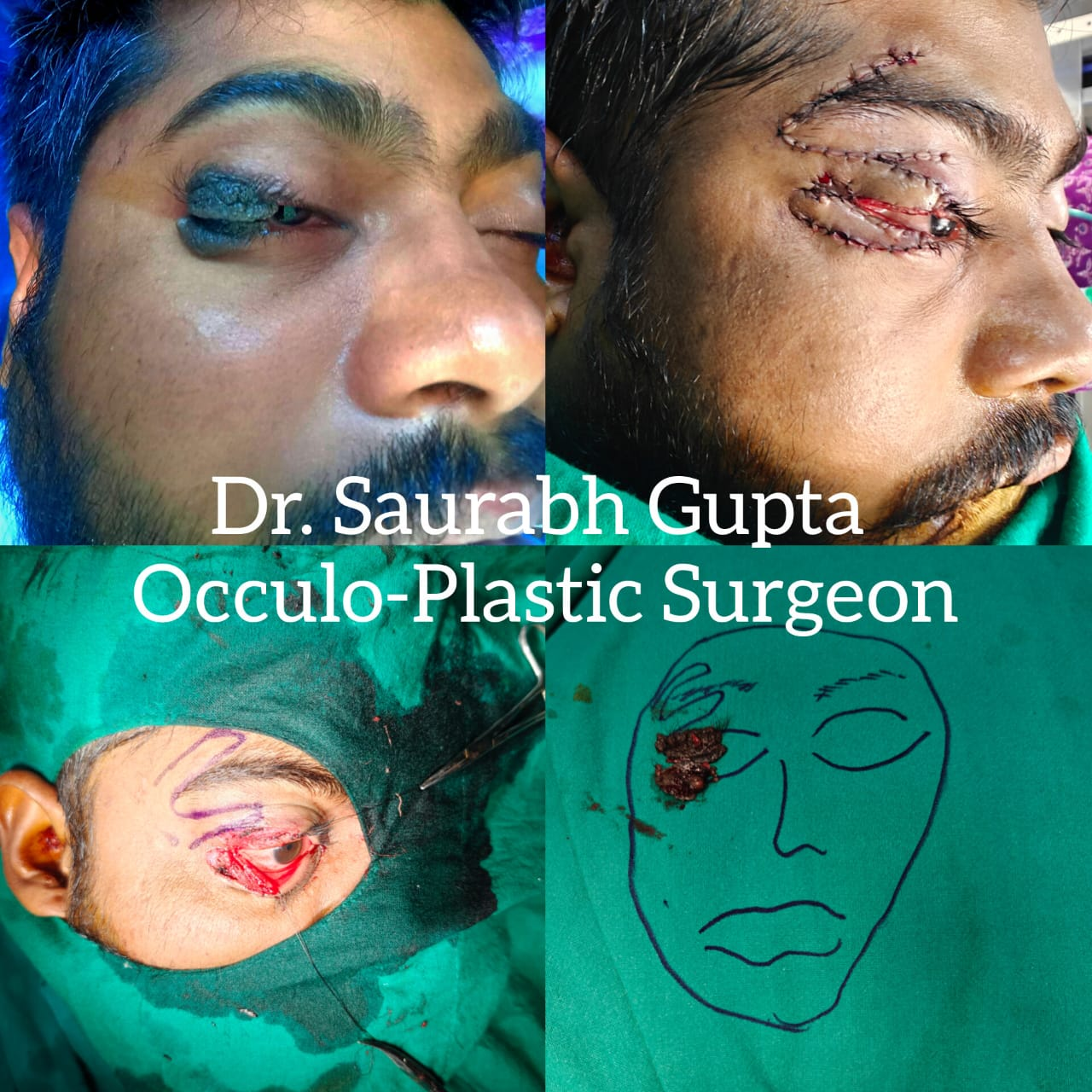 Breast Implant Surgery