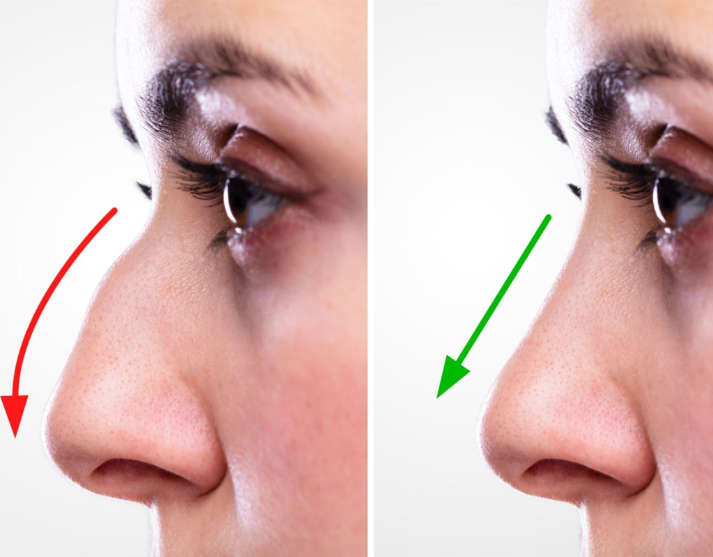 Rhinoplasty Surgery