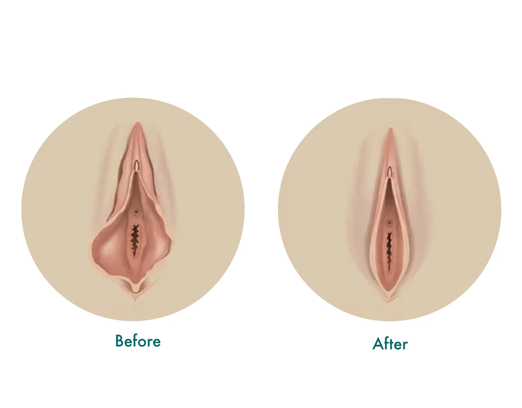 Vaginal Rejuvenation Treatment